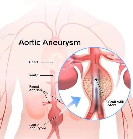 Best Doctor for Varicose Veins in Delhi NCR